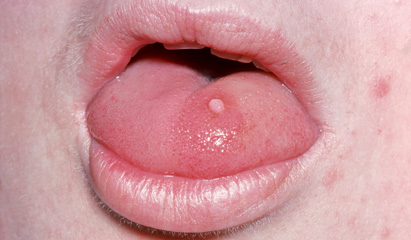 CAN CONDYLOMA (HPV) BE TRANSMITTED THROUGH ORAL SEX?